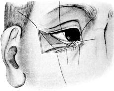 Modified Kuhnt&rsquo;s Operation