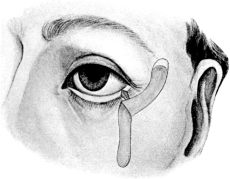 Argyll Robertson&rsquo;s Operation for Ectropion