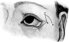 Denonvillier&rsquo;s Operation for Ectropion of the Lower Lid