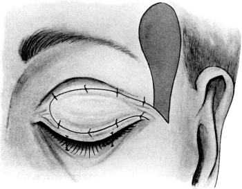 Fricke&rsquo;s Operation