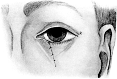 De Vincentiis&rsquo; Operation