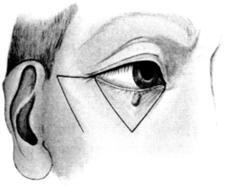 Modified Dieffenbach&rsquo;s Operation