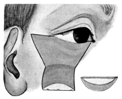 Modified Dieffenbach&rsquo;s Operation