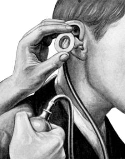 Method of using Siegle&rsquo;s Speculum
