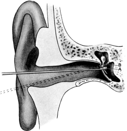 Removal of Malleus by Delstanche&rsquo;s Ring-knife
