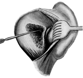 Schwartze&rsquo;s Operation completed