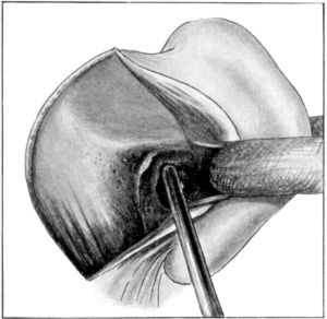 Stacke&rsquo;s Operation