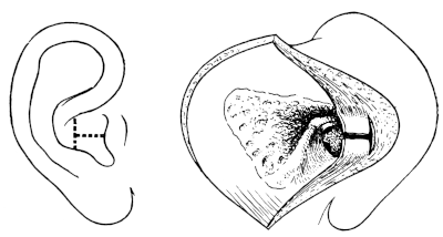 Panse&rsquo;s Post-meatal Flap