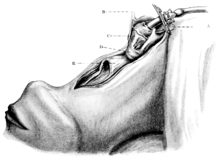 Total Laryngectomy. Gluck&rsquo;s Method.