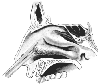 First Step in removing the Anterior End of the Inferior Turbinal,
which is seen to have undergone Polypoid Degeneration
