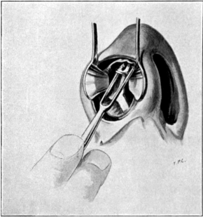 The Method of employing Ballenger&rsquo;s Swivel Septum Knife