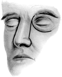 Incisions for Lateral Rhinotomy (Moure&rsquo;s Operation)