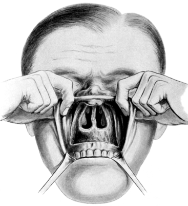 Rouge&rsquo;s Operation