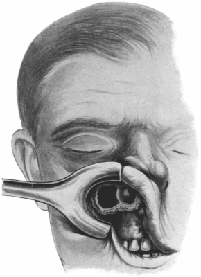 Denker&rsquo;s Operation