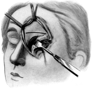 Killian&rsquo;s Operation upon the Frontal Sinus