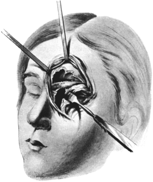 Killian&rsquo;s Operation upon the Frontal Sinus