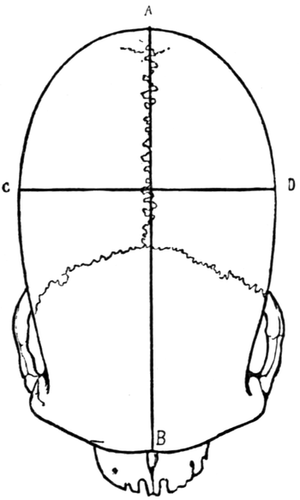 Dolichocephalic Skull