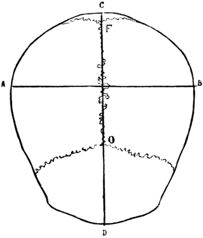 Dolichocephalic Skull