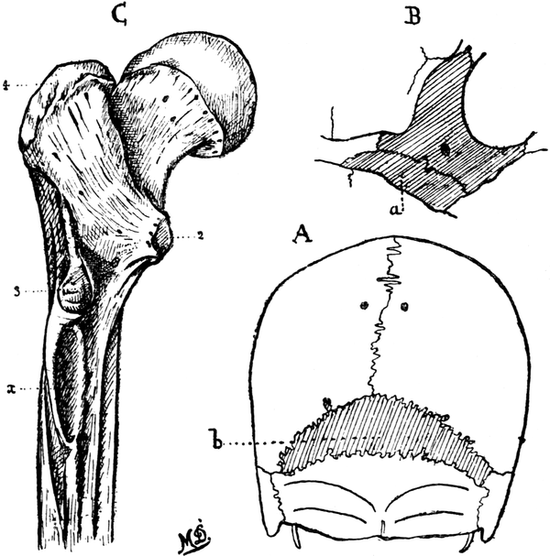 Skull, Malar Bone, Femur