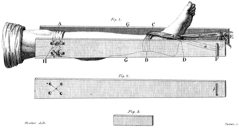 A practical treatise on fractures and dislocations . inside of the  thigh,but also the direction of the counter-extension is in a line with  theaxis of the body. The posterior extremity of this