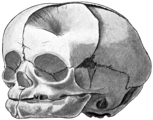 The Project Gutenberg Ebook Of The Surgery Of The Skull And Brain